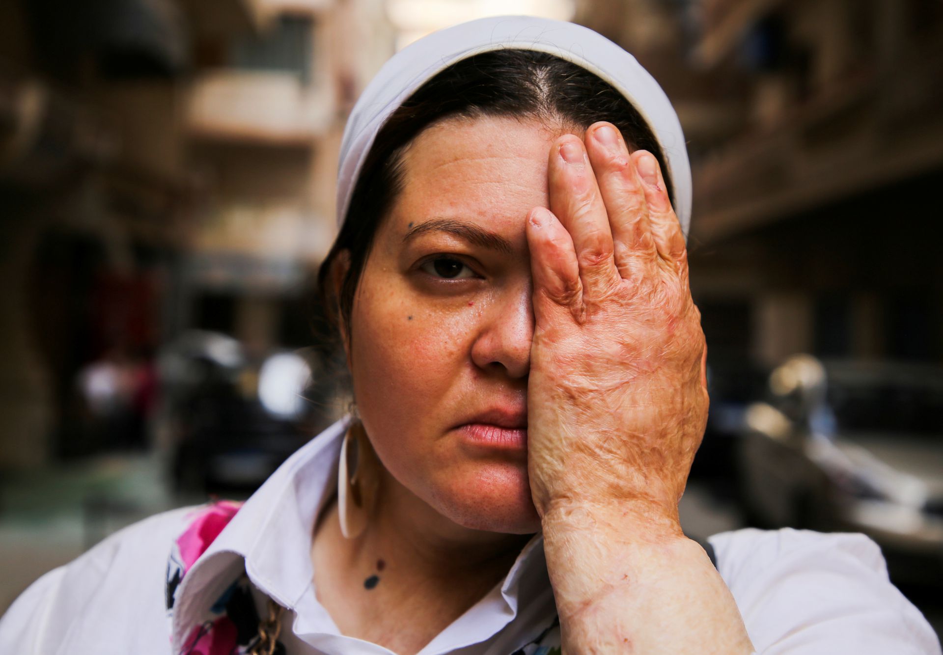 Egyptian group helps burn victims fight stigma
