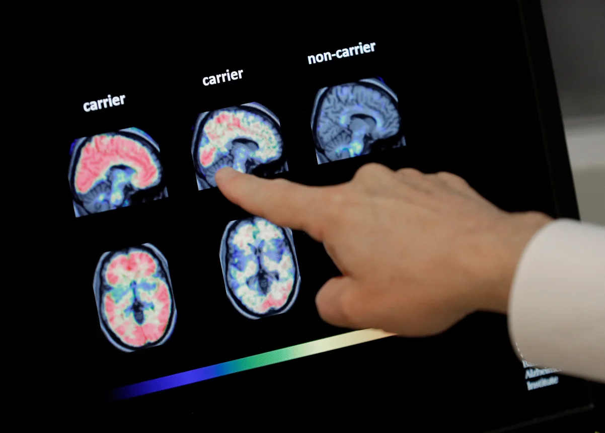 FDA greenlights first blood test to help diagnose Alzheimer’s disease in the US